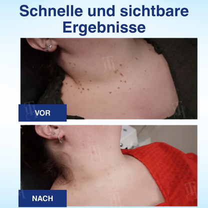 🌟 Offizieller Shop | Cvreoz® AHA Warzenentfernungsflüssigkeit