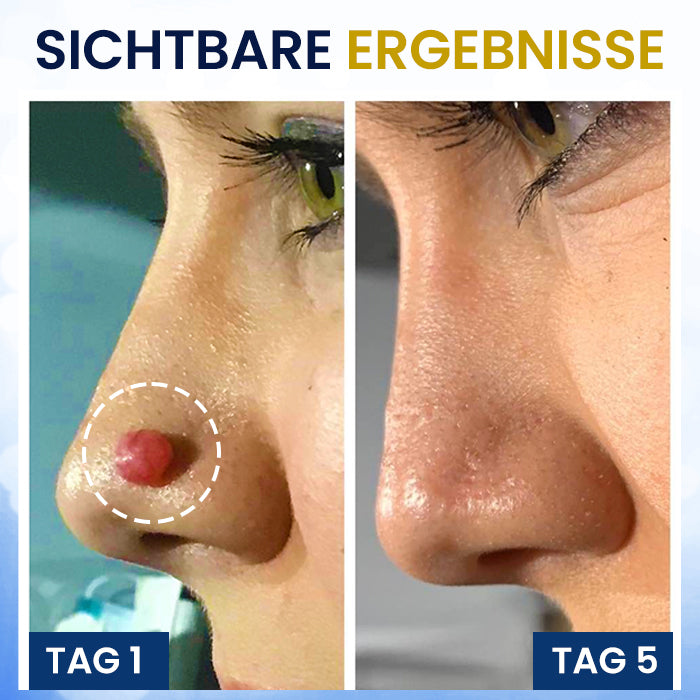 🌟 Offizieller Shop | AEXZR® Hautanhängsel-Kryo-Behandlungsspray